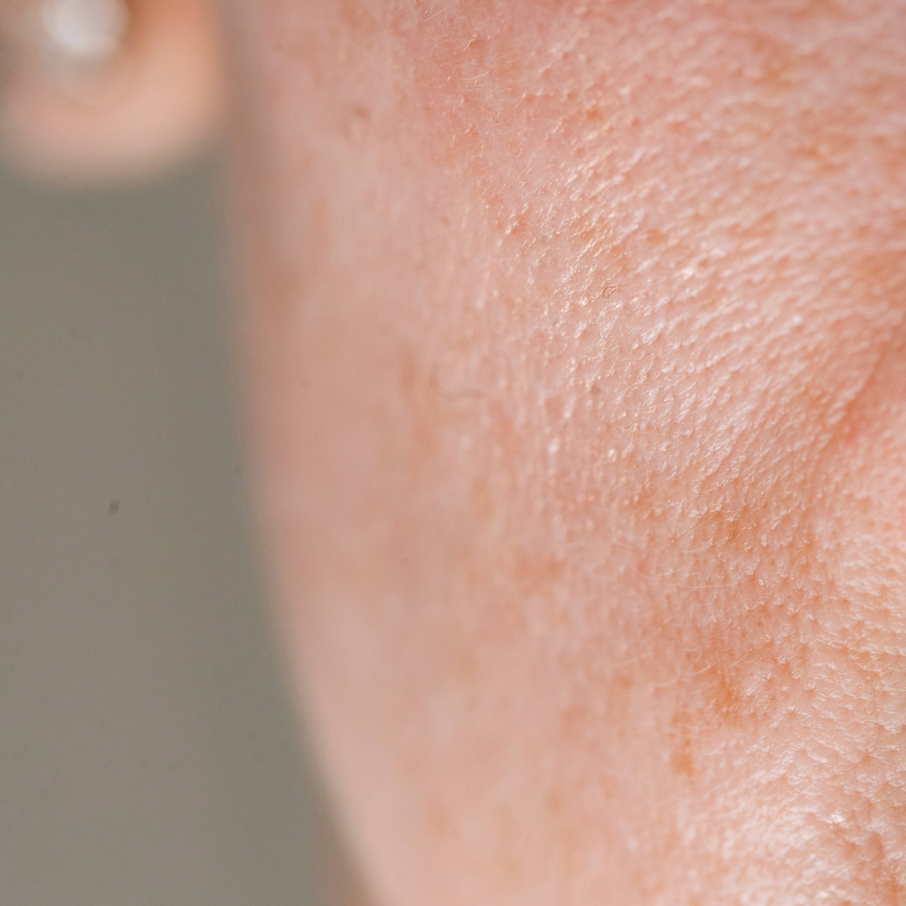 What causes enlarged pores?